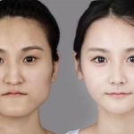 【衝撃】200万使って整形した結果ｗｗｗｗｗｗｗｗｗｗｗｗ