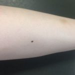 【衝撃画像】手の甲にいきなりデカイ黒子ができた…これ癌やろ…（※画像あり）