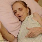 【死に直面】ビールだけしか飲まなかった女性、かなりえずき、やせたかなしい姿に・・・（画像あり）